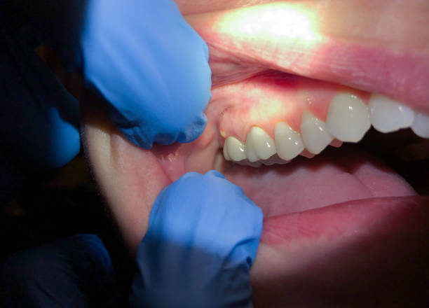 Best Knocked-Out Tooth (Avulsed Tooth) Treatment in Herington, KS
